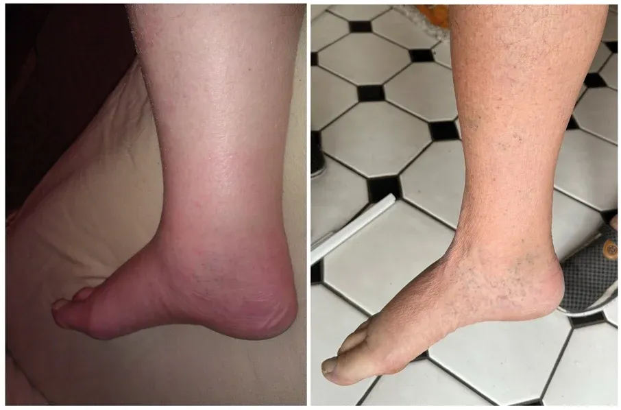 Watch Swollen Legs Method